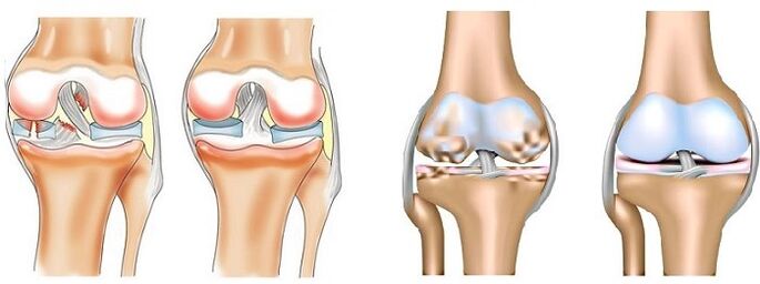 Gịnị bụ ogbu na nkwonkwo na arthrosis